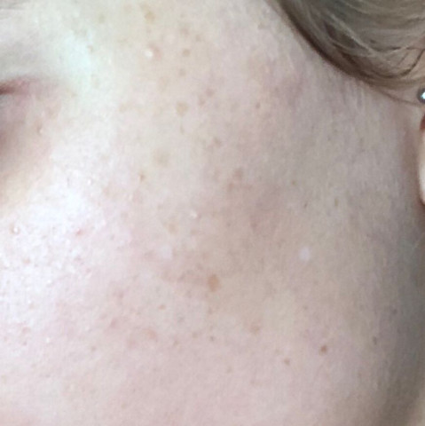 Unreine Fleckige Haut Im Gesicht Gesundheit Und Medizin Pickel Unreinheiten Unreine Fleckige Haut Im Gesicht Gesundheit Und Medizin Pickel Unreinheiten