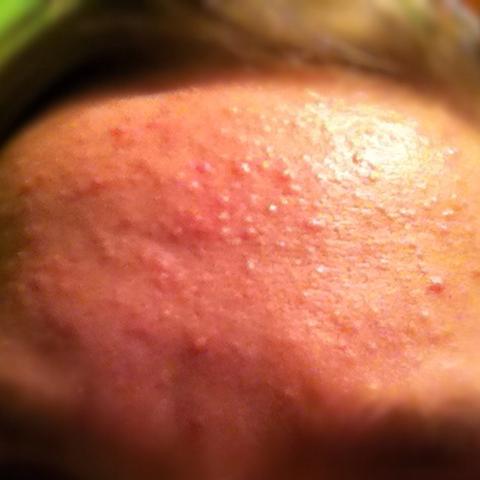 pickel auf der stirn pubertät pickel auf der stirn pubertät