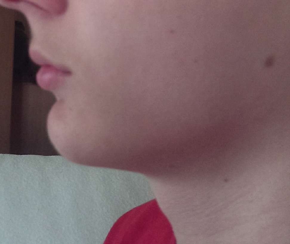 Unschönes Kinn (Aussehen)