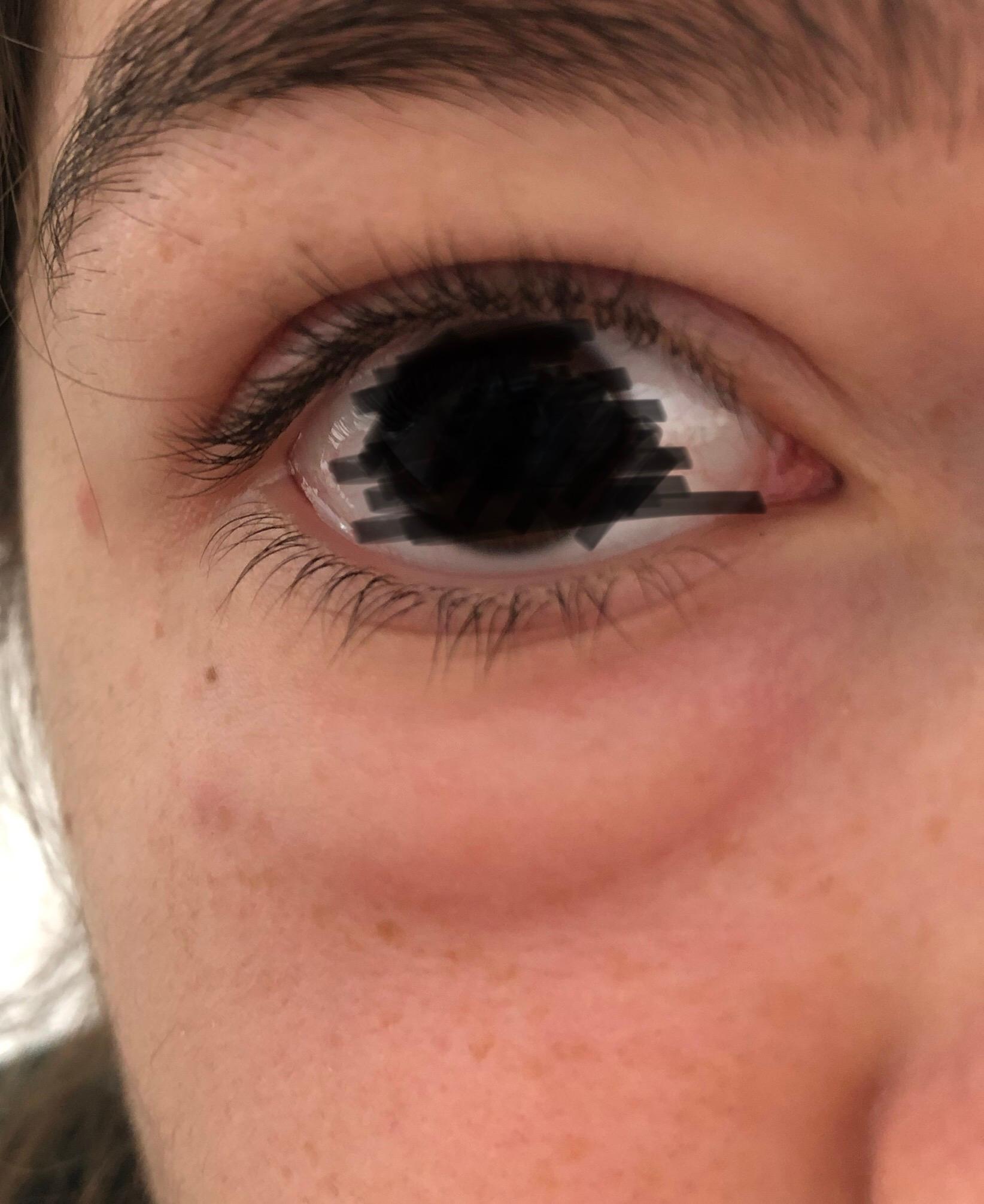 Geschwollene Augenlider Muckenstich Geschwollene Augenlider Muckenstich