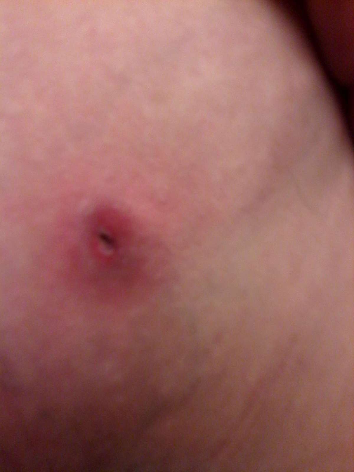 Unter Der Haut Nach Eiter Ausdrucken Ein Loch Und Eine Kugel Was Tun Gesundheit Abszess Unter Der Haut Nach Eiter Ausdrucken Ein Loch Und Eine Kugel Was Tun Gesundheit Abszess