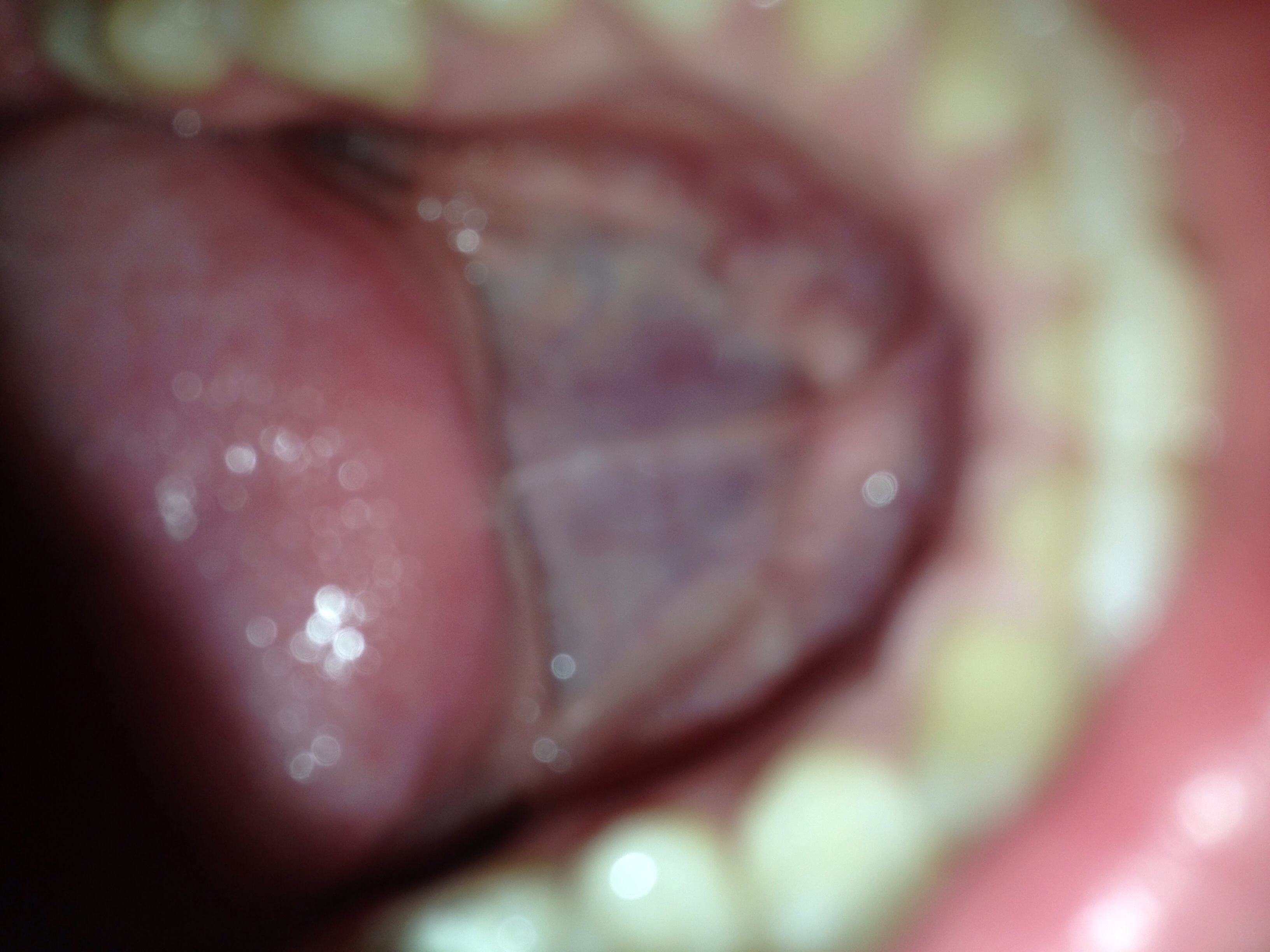 Unter der Zunge ein Hubbel was ist das? (Mund)