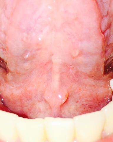 Unter Der Zunge Ein Knubbel Und Taubheitsgefuhl Gesundheit Taubheitsgefuehl Unter Der Zunge Ein Knubbel Und Taubheitsgefuhl Gesundheit Taubheitsgefuehl