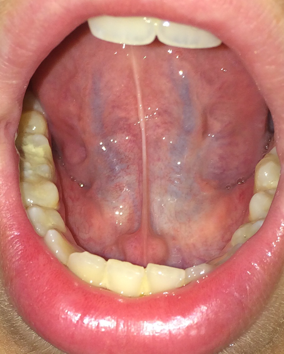 50+ Knoten unter der zunge bilder , Was sind das für blaue Streifen unter meiner Zunge? (Gesundheit