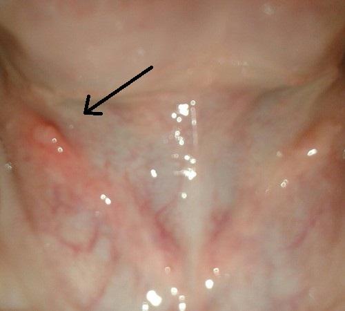 Unter Meiner Zunge Entzundete Speicheldruse Oder Was Ist Da Los Entzundung Mund Drusen Unter Meiner Zunge Entzundete Speicheldruse Oder Was Ist Da Los Entzundung Mund Drusen