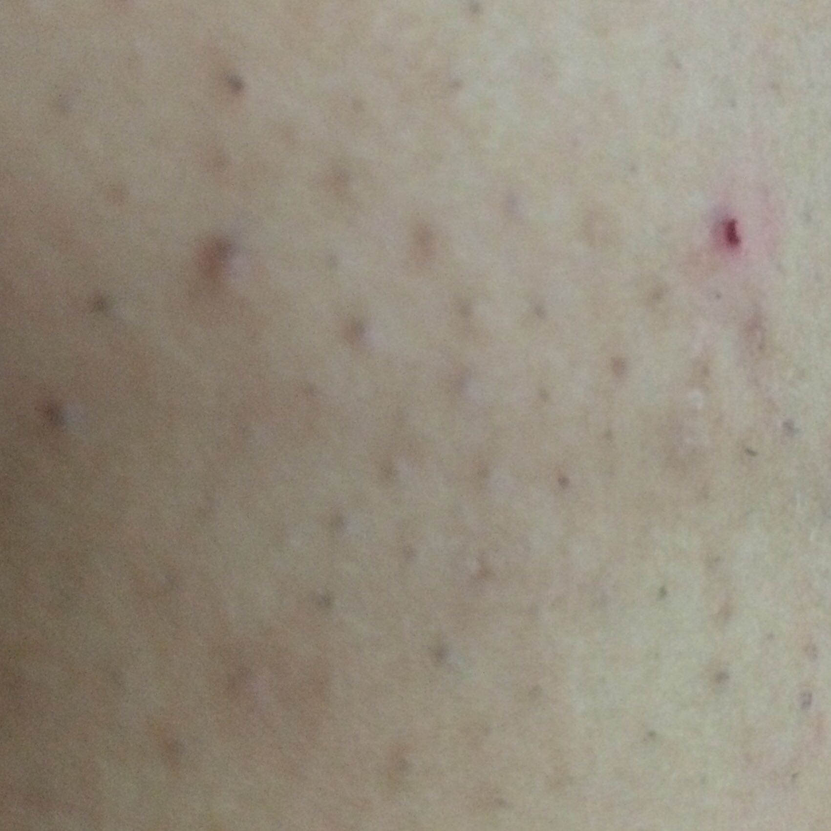 unterem bauch bereich schwarze dicke