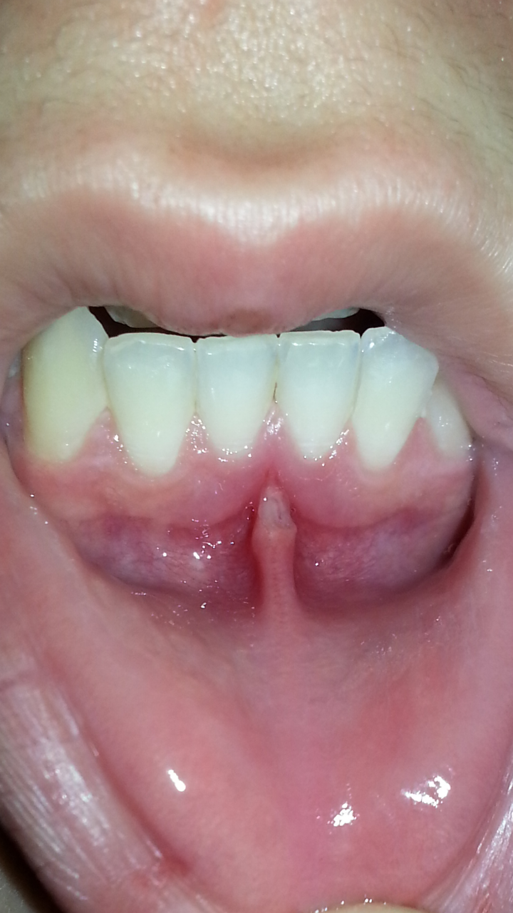 Unteres Lippenbändchen angerissen und weiss (Schmerzen, weiß, Pilze)