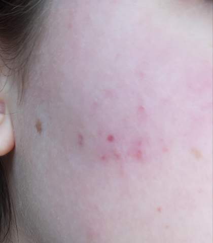 Unterirdische Pickel wange loswerden? (Haut) pickel in der wange innen