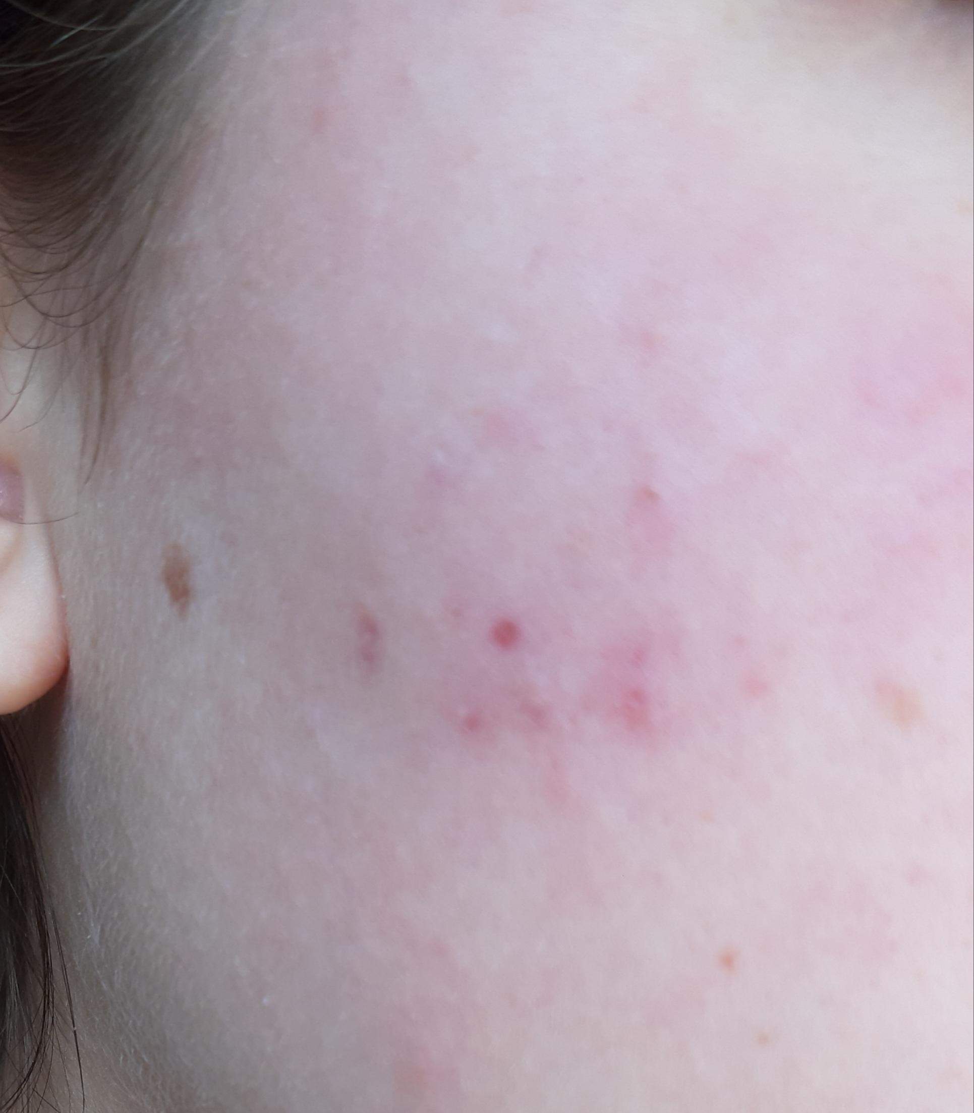 Unterirdische Pickel wange loswerden? (Haut) pickel auf der wange loswerden