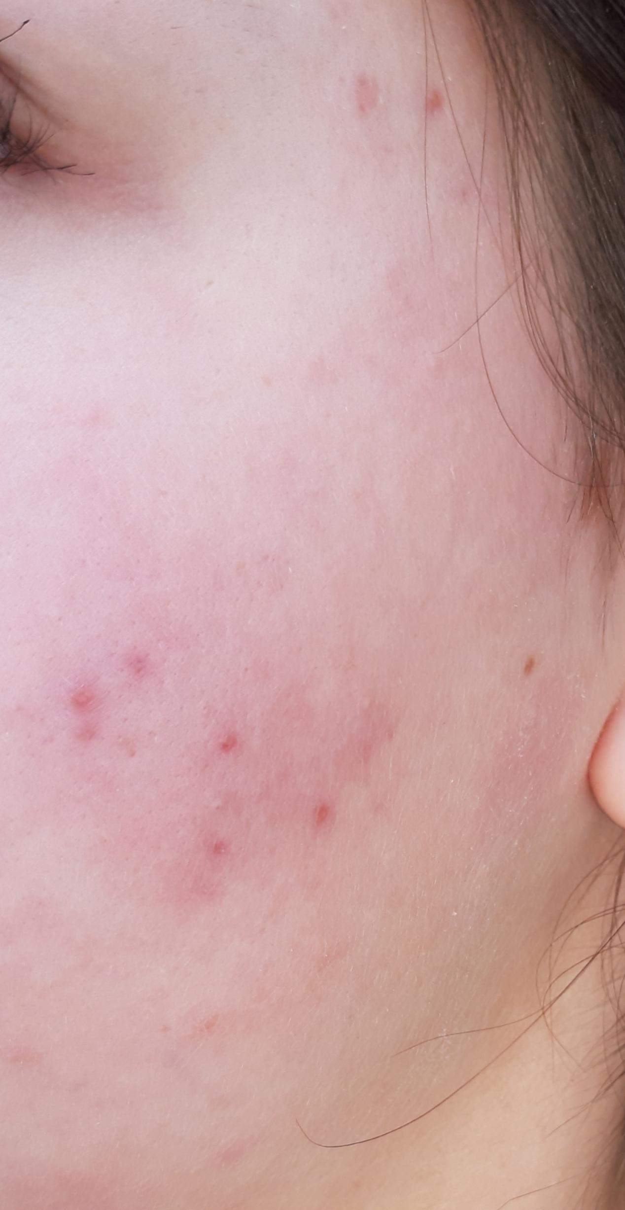 Unterirdische Pickel wange loswerden? (Haut) pickel an der wange ursache