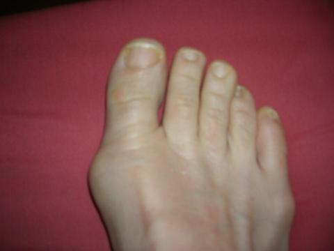 Unterschied Knochenhautentzundung Oder Uberbein Gesundheit Fusse Unterschied Knochenhautentzundung Oder Uberbein Gesundheit Fusse