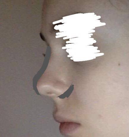 Unzufrieden Mit Meiner Nase Op Mit Foto Gesundheit Beauty Schonheit Unzufrieden Mit Meiner Nase Op Mit Foto Gesundheit Beauty Schonheit
