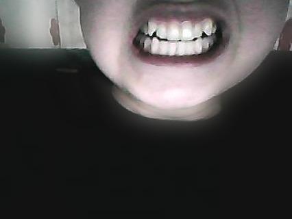 Vampirzahne Zahnspange Kosten Zahnarzt Eckzahn