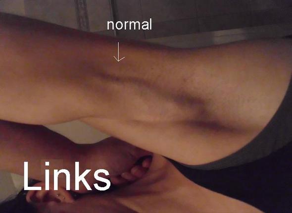 Vene Unter Achsel Arm Ausgebeult Gesundheit Vene Unter Achsel Arm Ausgebeult Gesundheit