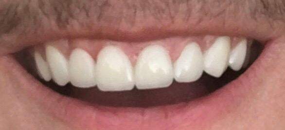 Zahnfarbe hellste Weiße Zähne