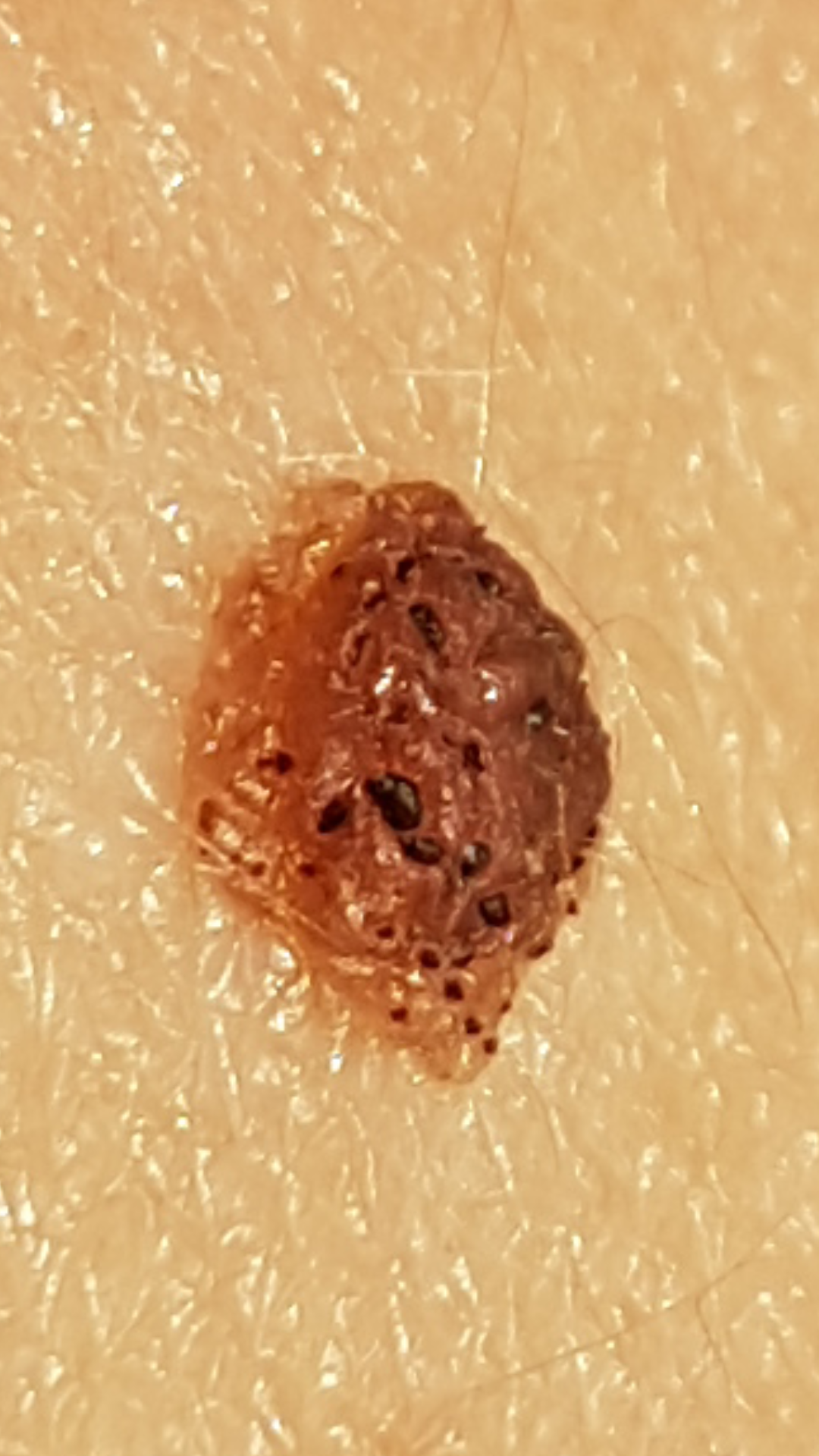 Verändertes Muttermal Hautkrebs? (Arzt, Hautarzt, Dermatologie)