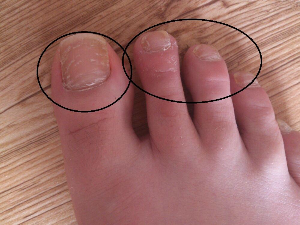 Veränderung der Fußnägel Was kann das sein? (Füße, Nägel)