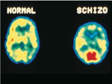 Links ''gesund'' ; Rechts ''schizophren''. - (Körper, Krankheit, Psyche)