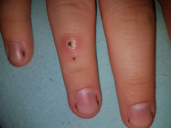 - (Gesundheit und Medizin, Wunde, Finger)
