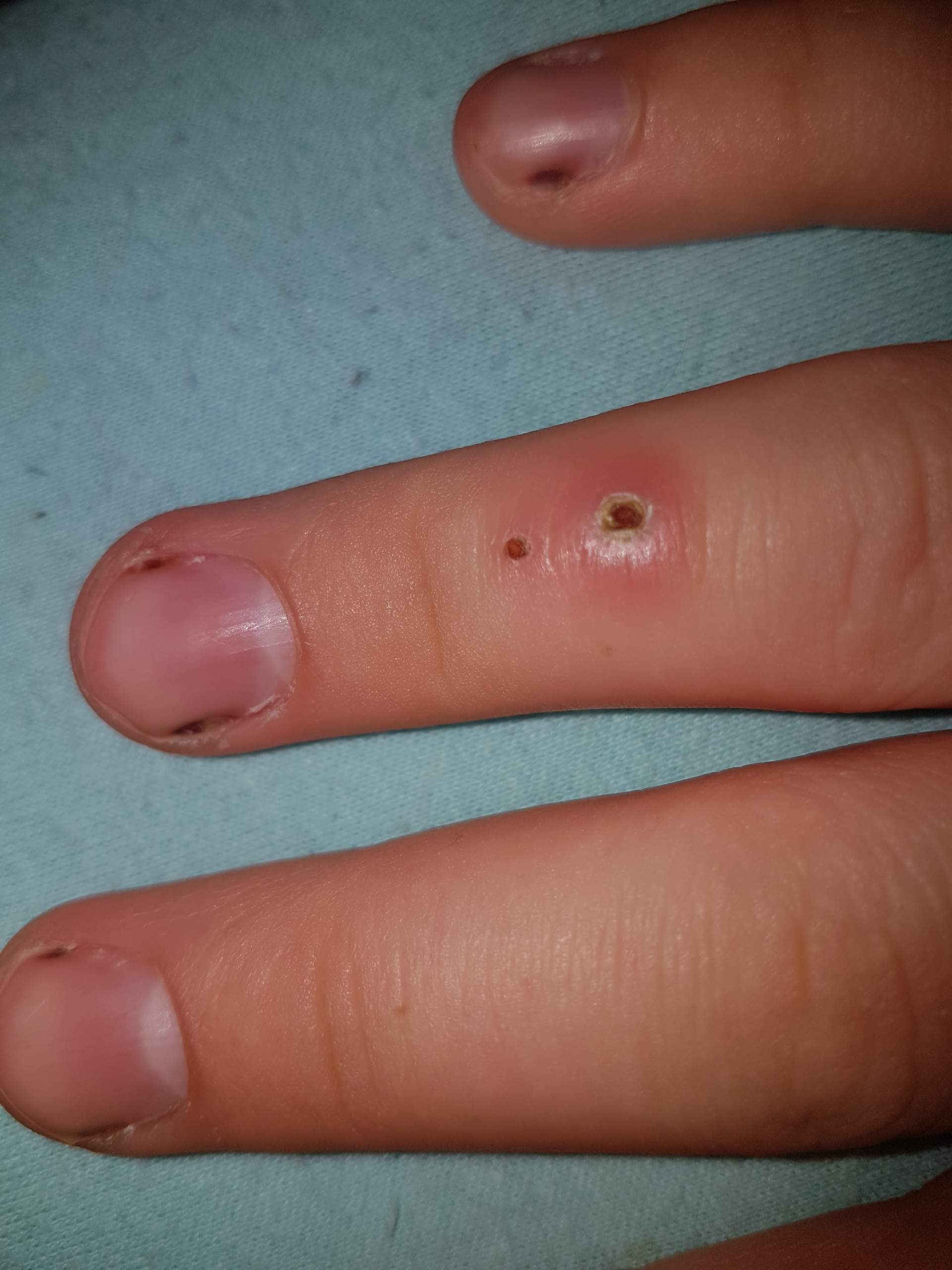 Verätzung arg entzündet? (Gesundheit und Medizin, Wunde, Finger)