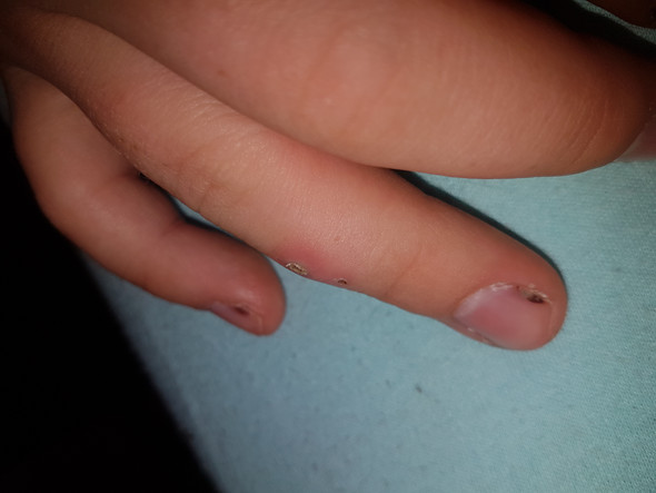 - (Gesundheit und Medizin, Wunde, Finger)