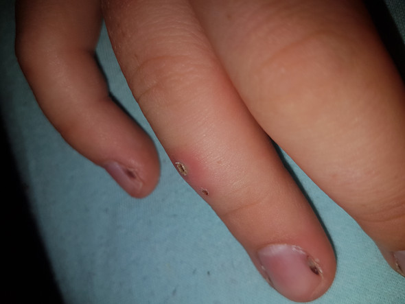 - (Gesundheit und Medizin, Wunde, Finger)