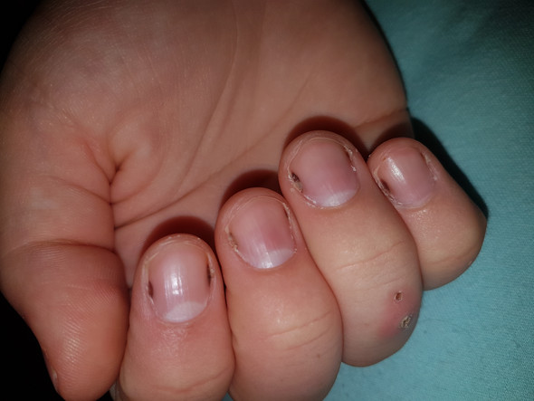 - (Gesundheit und Medizin, Wunde, Finger)