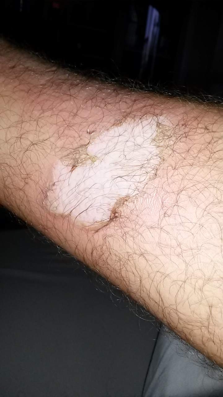 Verbrennung 1., 2. oder 3 grades? ich habe mich gerade am krümmer Verbrennung 1., 2. oder 3 grades? ich habe mich gerade am krümmer