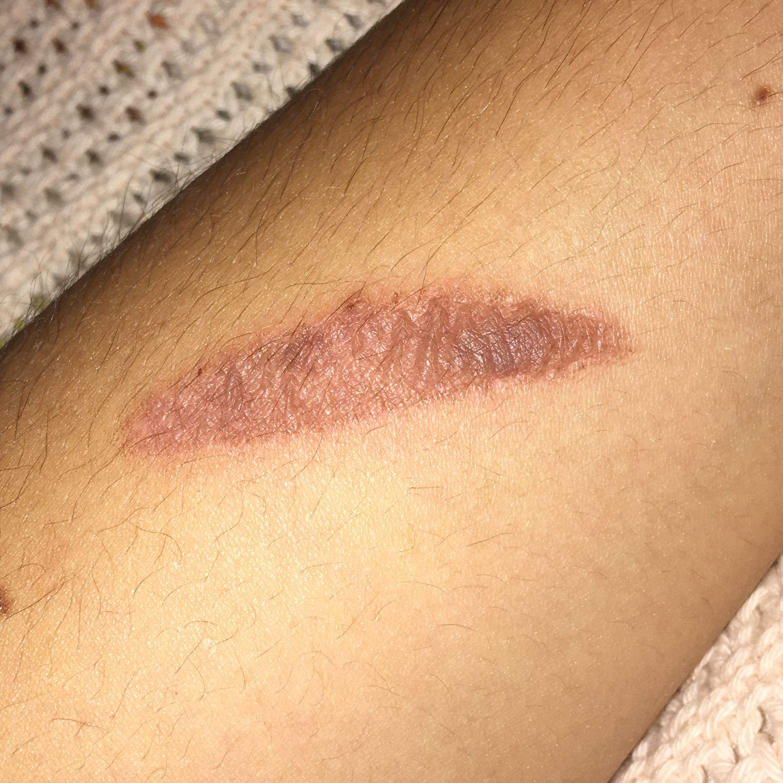 Verbrennung 1. oder 2. grades? (Gesundheit und Medizin, Haut, Dermatologie)