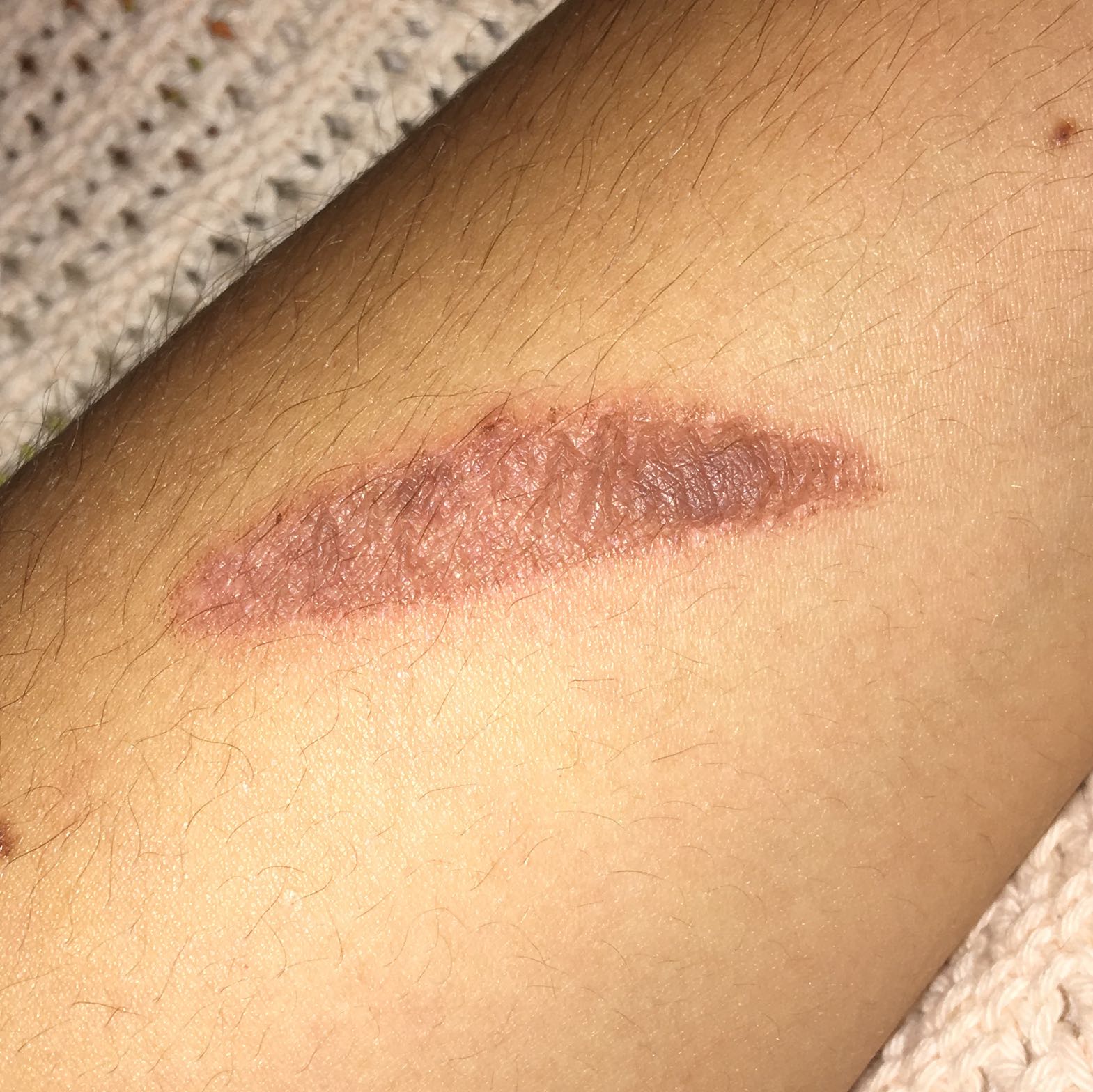 Verbrennung 1 Oder 2 Grades Gesundheit Und Medizin Haut Dermatologie Verbrennung 1 Oder 2 Grades Gesundheit Und Medizin Haut Dermatologie