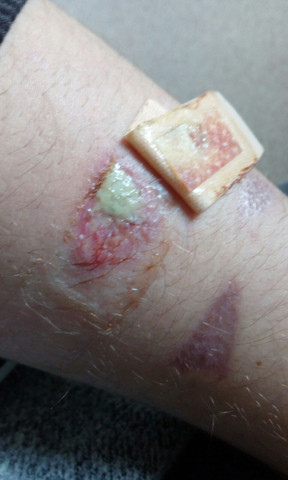 Verbrennung entzündet ? (Arzt)