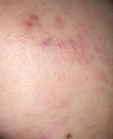 Verbrennung Mit Heisswachs Im Gesicht Was Tun Chemie