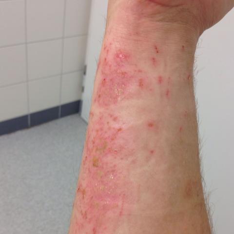 So sieht das aus . - (Krankenhaus, Verbrennung)