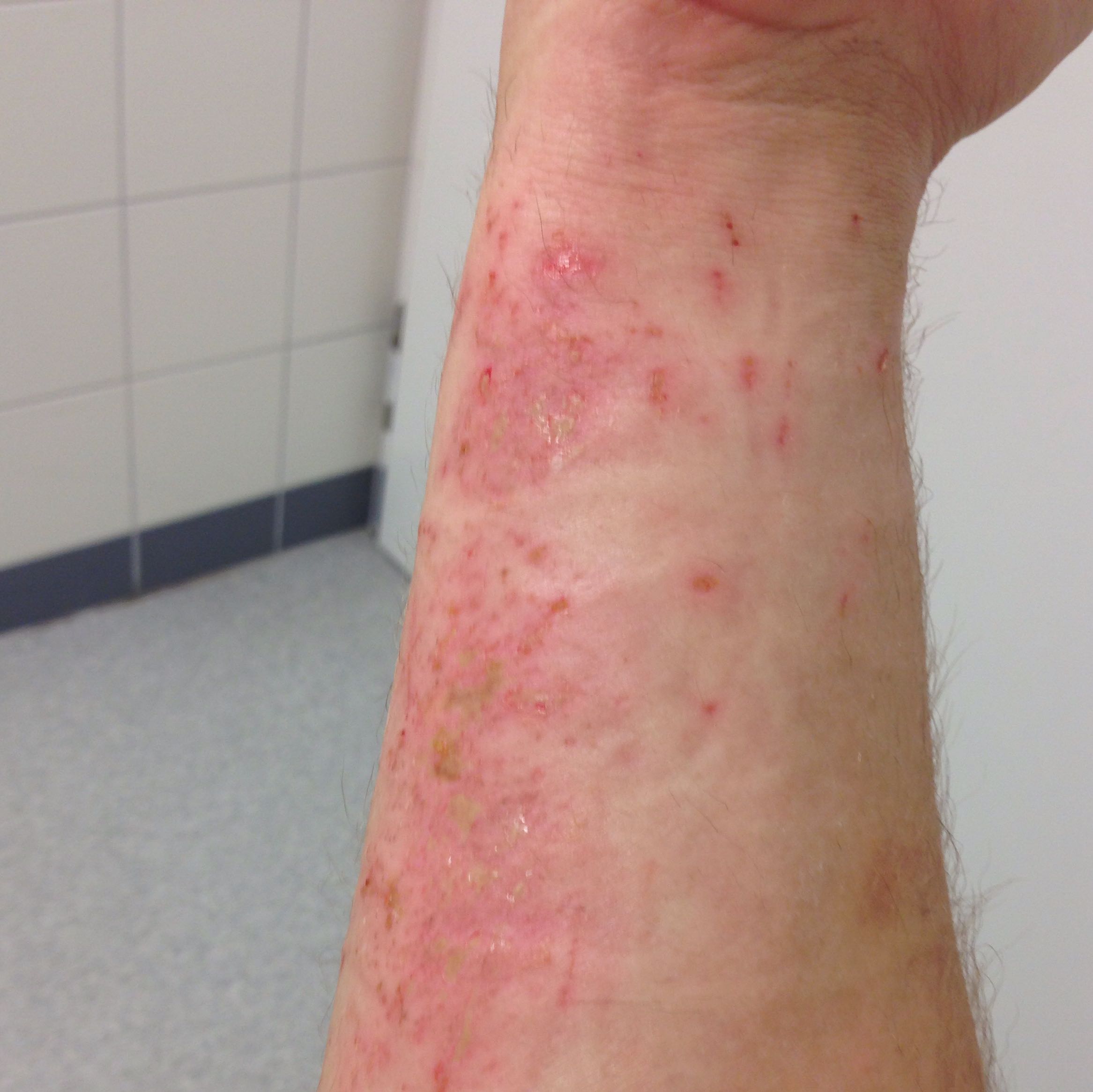 Verbrennung muss ich damit in Krankenhaus?