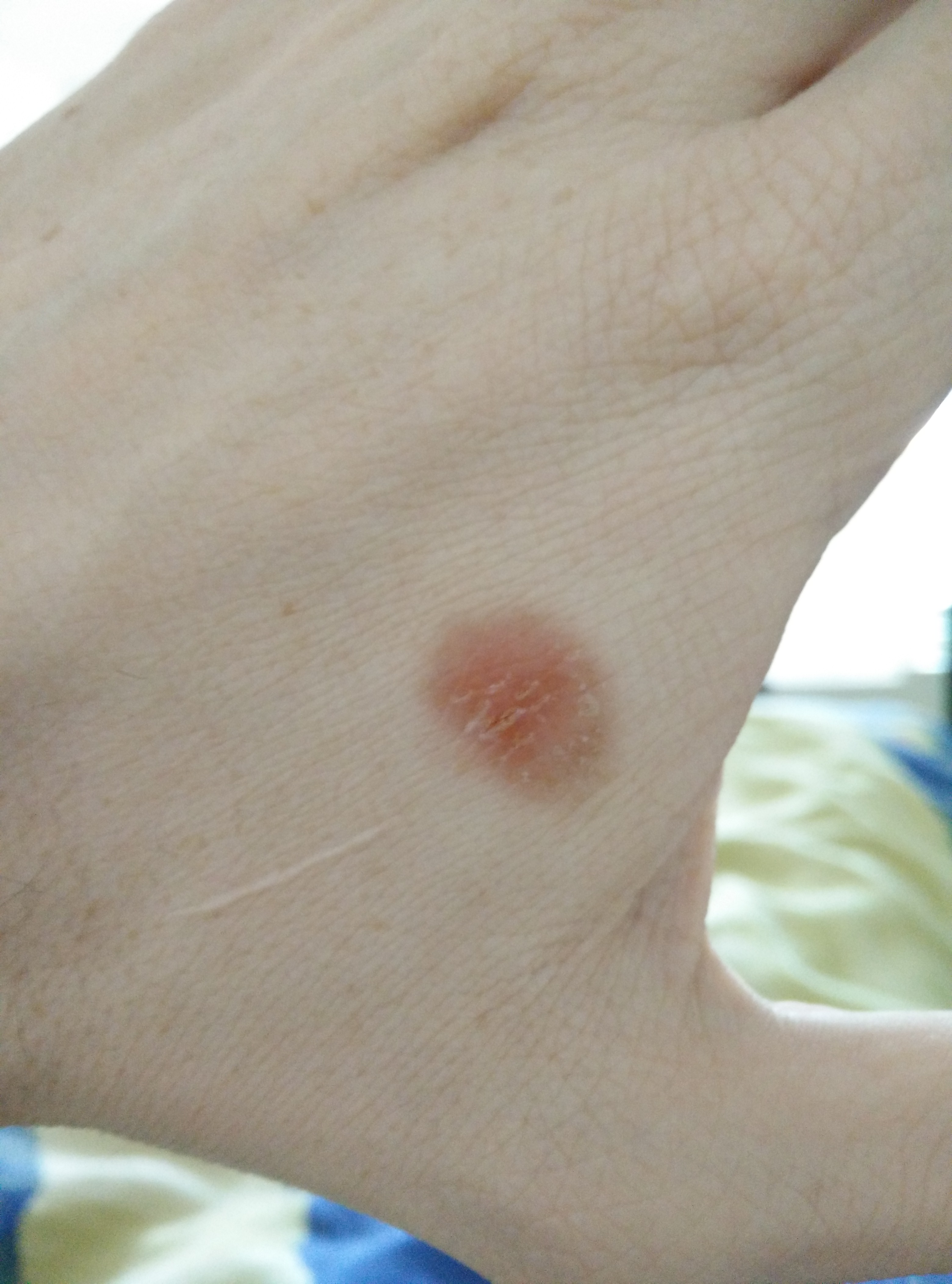Verbrennung (nicht offen) was tun? (Medizin, Haut, Arzneimittel)