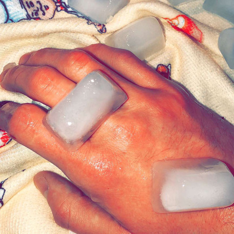 Verbrennung Wasserkocher Gesundheit Und Medizin Schmerzen Brandblase Verbrennung Wasserkocher Gesundheit Und Medizin Schmerzen Brandblase