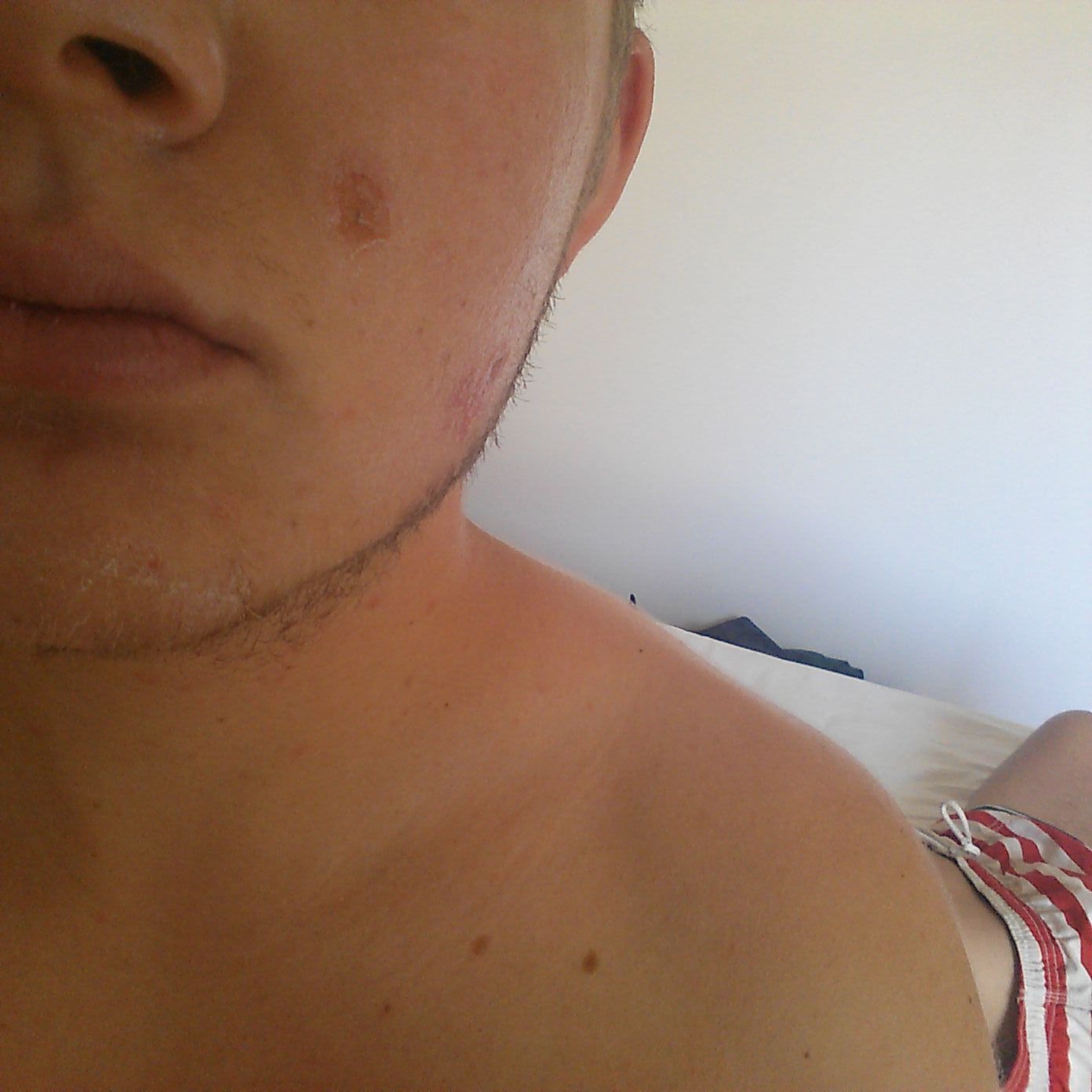 Verbrennungen Im Gesicht Durch Sonne Bitte Um Hilfe Medizin Haut Schutz