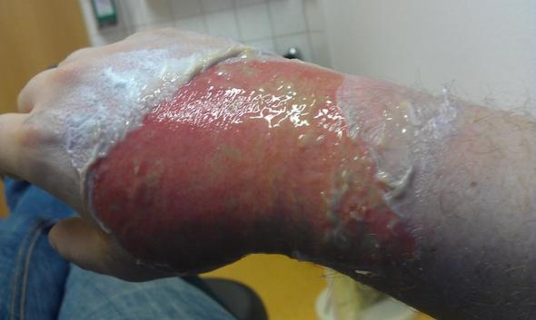 Verbrennungen ins Krankenhaus? (Arzt, Verbrennung, Chirurgie) Verbrennungen ins Krankenhaus? (Arzt, Verbrennung, Chirurgie)