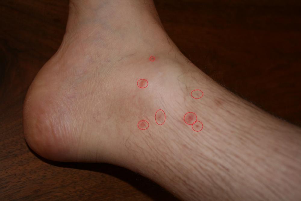 Verdacht auf Bettwanzen, was tun? Brauche eine Einschätzung von