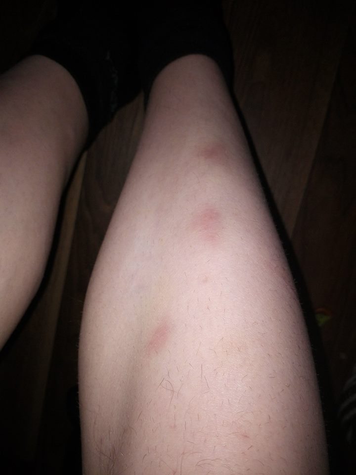 Verdacht Auf Leukamie Oder Doch Was Simples Angst Krebs Flecken Verdacht Auf Leukamie Oder Doch Was Simples Angst Krebs Flecken