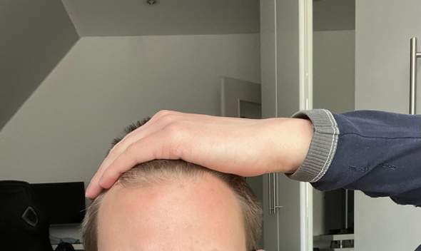 Verdammter Haarausfall erblich bedingt Zeit für glatze?