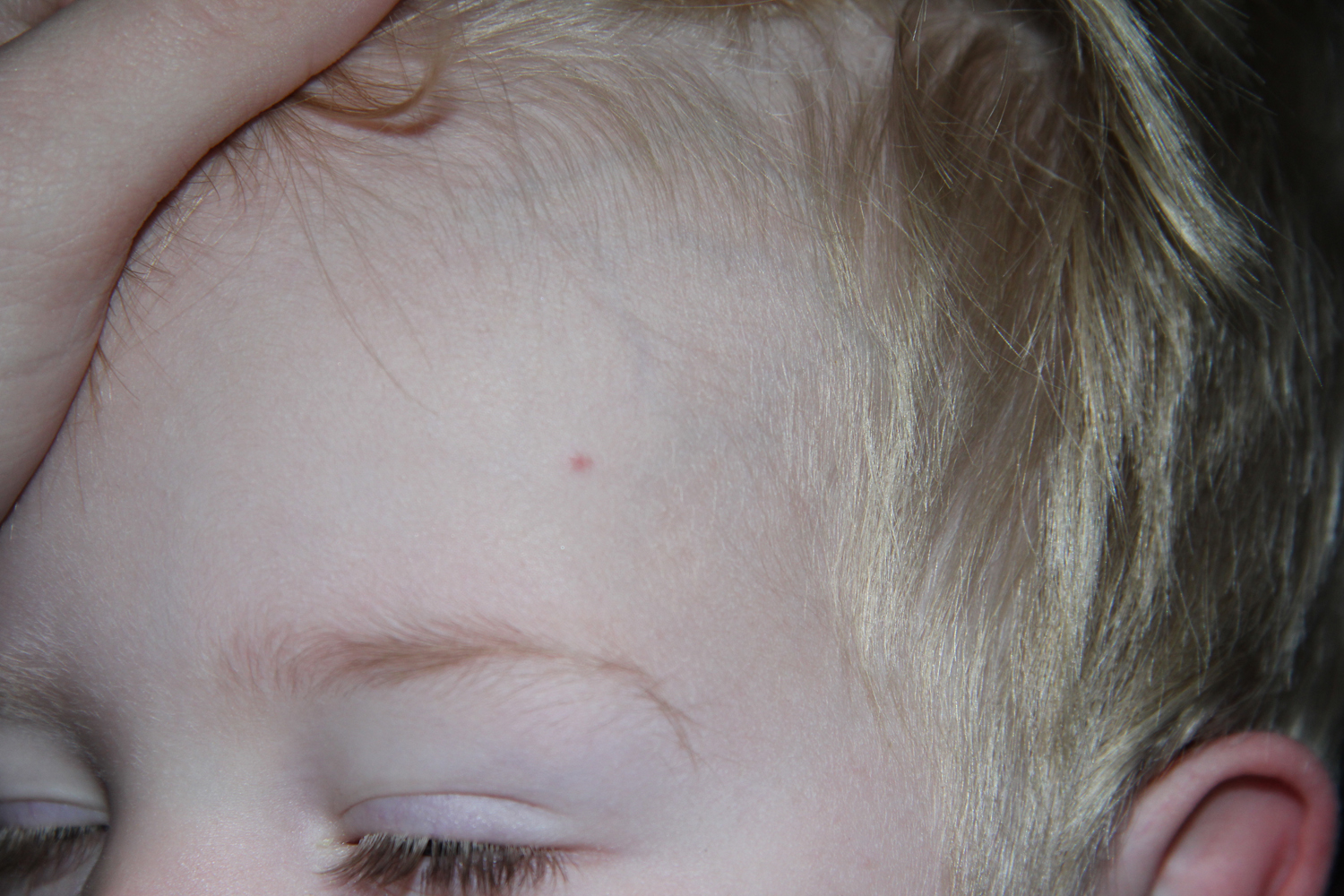 Pickel im gesicht englisch pickel im gesicht und hals