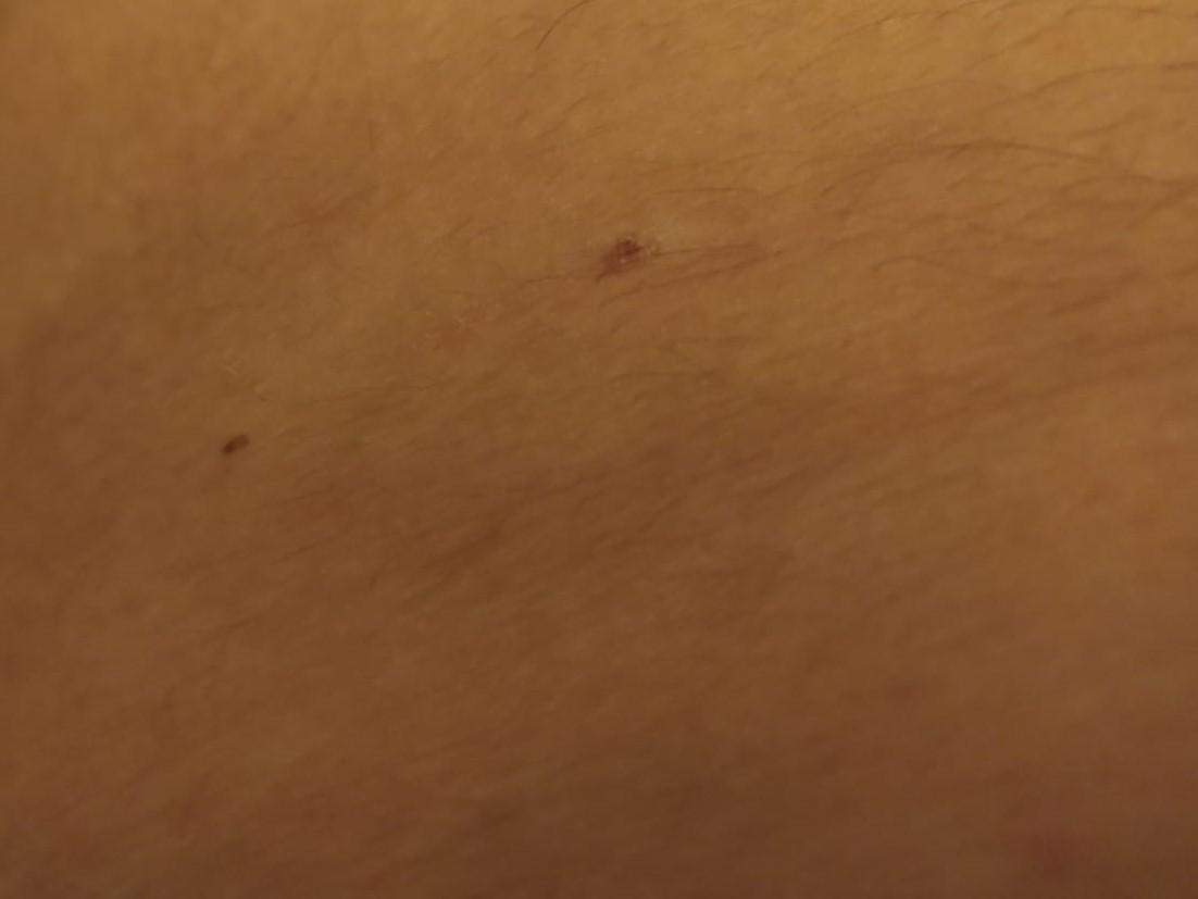 Vereinzelte kleine Pusteln auf der Haut die Jucken? (Gesundheit und