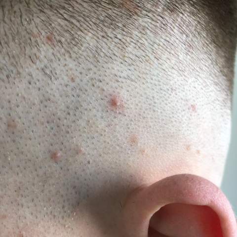 Vereinzelte Pickel auf der Kopfhaut? (Gesundheit und Medizin) pickel auf kopfhaut