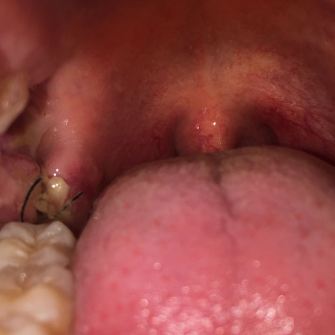 Detail - (Gesundheit, Zähne, Entzündung)