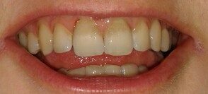 Verfärbung der vorderen Zähne, was tun? (Pflege)