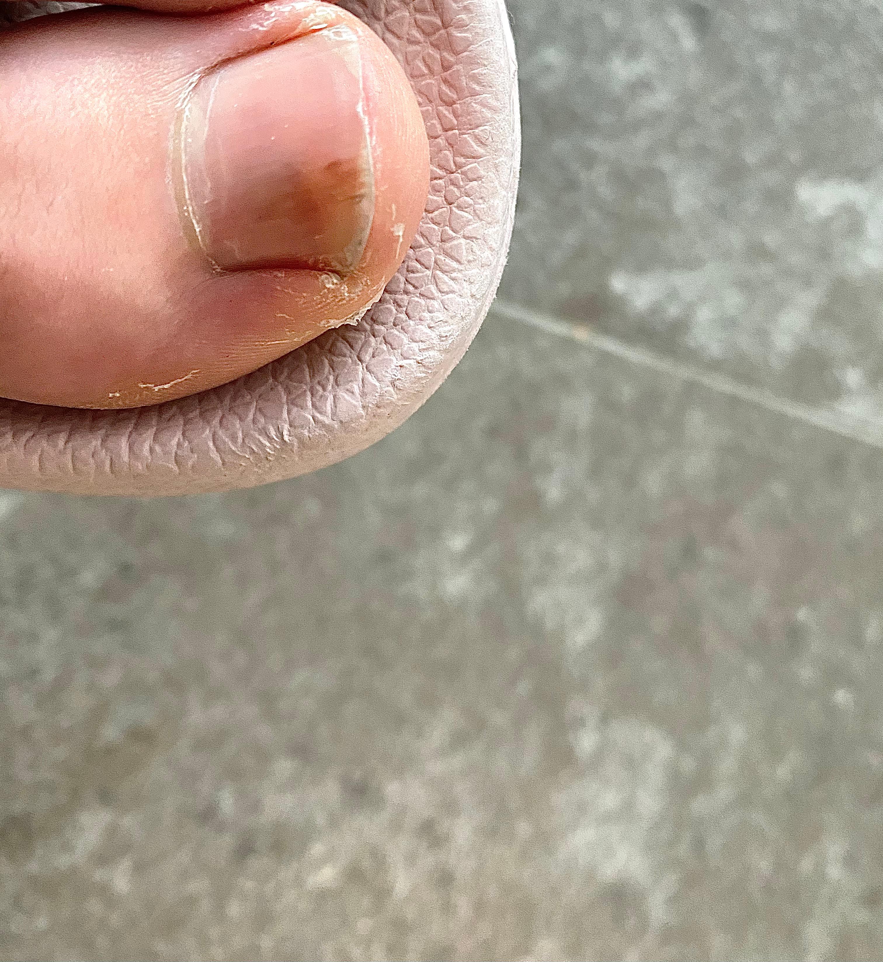 Verfarbung Meines Zehennagels Gesundheit Und Medizin Verfarbung Meines Zehennagels Gesundheit Und Medizin