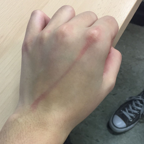 Piercing Unter Der Haut Bilder