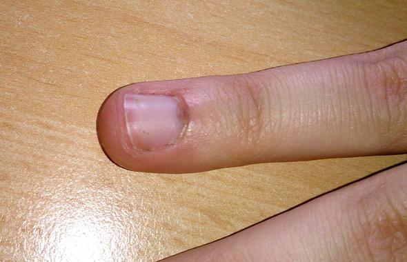 R Ringfinger  - (Medizin, Fingernägel, nagelbett)