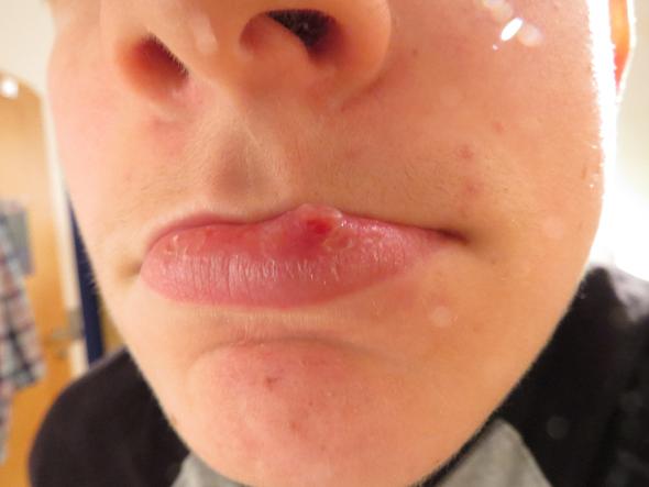 46 neu Foto Bläschen Lippe Innen / Ist das ein aphthen? (medizin und ...